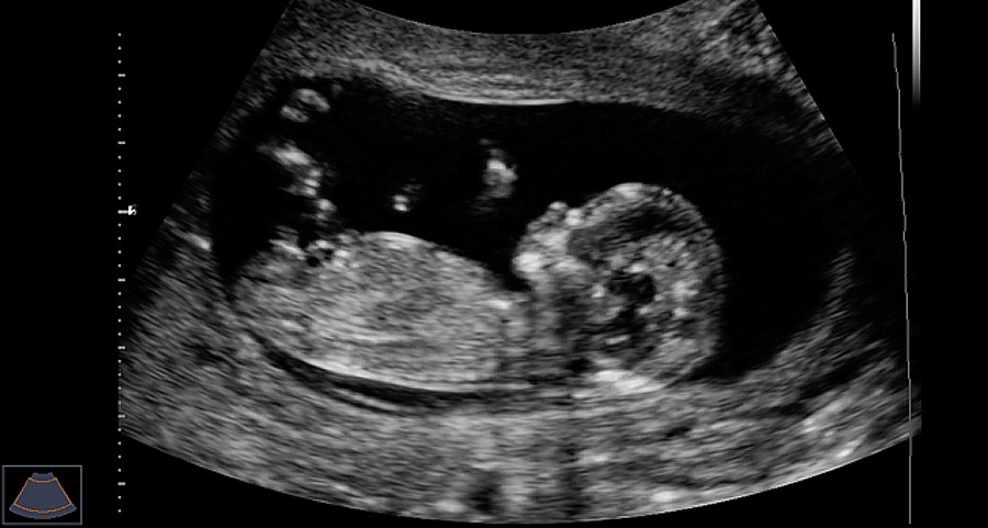 Как выглядит ребенок на 12 неделе беременности фото узи