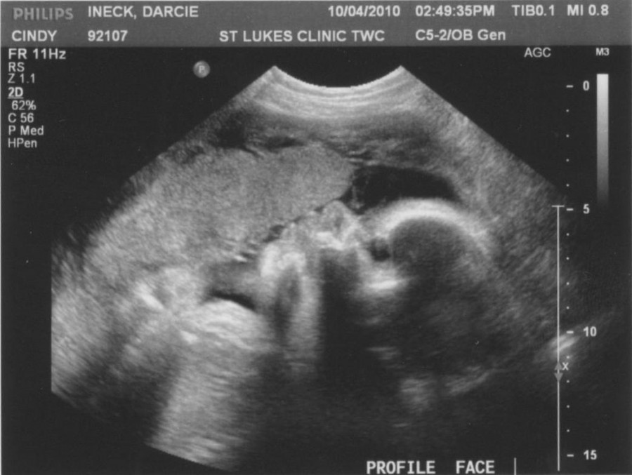 13 неделя беременности - ощущения, развитие плода, вес и размер малыша