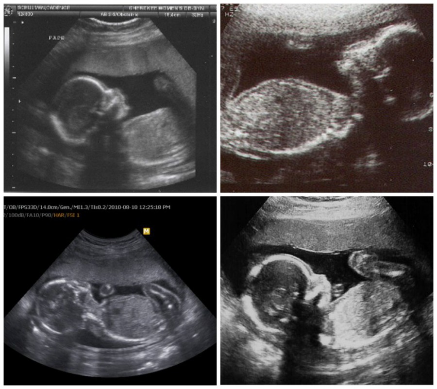 Фото узи на 22 неделе беременности фото