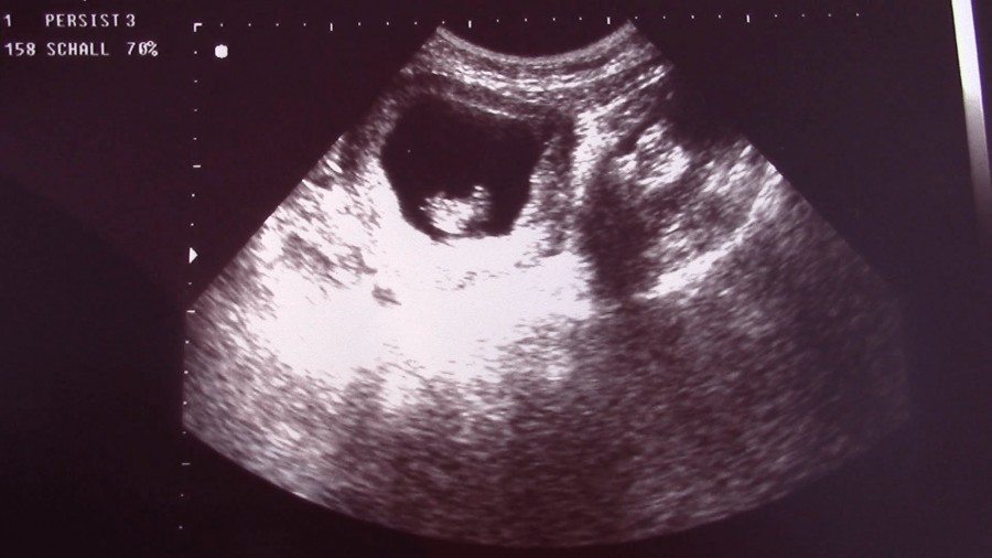 Вторая беременность живот на 9 неделе