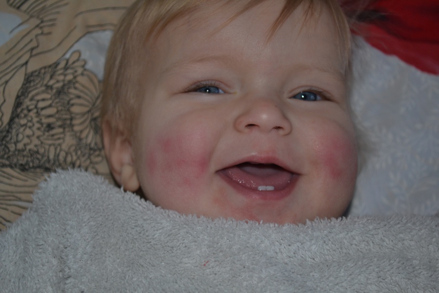 У ребенка горят щеки. Обмараживание щек у ребенка. Аллергия красные щеки у ребенка.