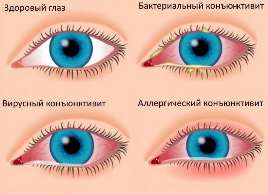 Конъюнктивит глаз симптомы у детей фото