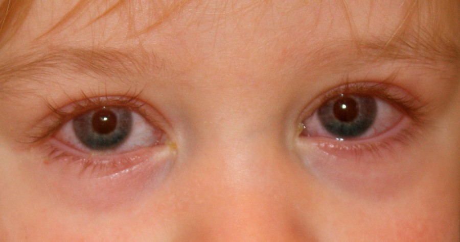Конъюнктивит глаз симптомы у детей фото