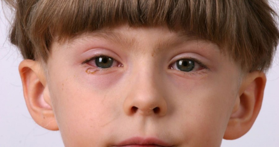 Симптомы конъюнктивита у детей фото