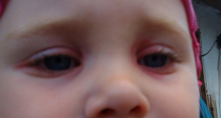 Красные глаза у ребенка причины фото