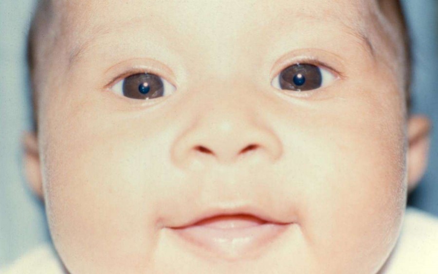 Покраснение глаза у ребенка лечение фото