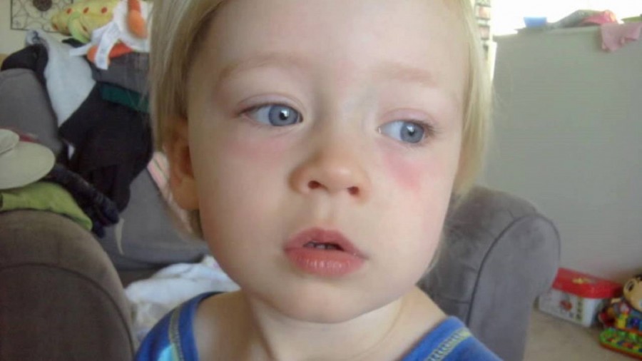Красные глаза причины и лечение у ребенка фото