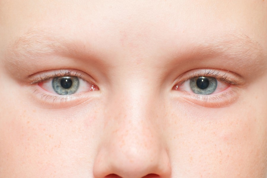 У ребнка красные глаза признаки патологии и основные терапевтические методы для снятия покраснения