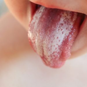 Молочница у детей во рту – причины появления, симптомы и лечение в домашних условиях