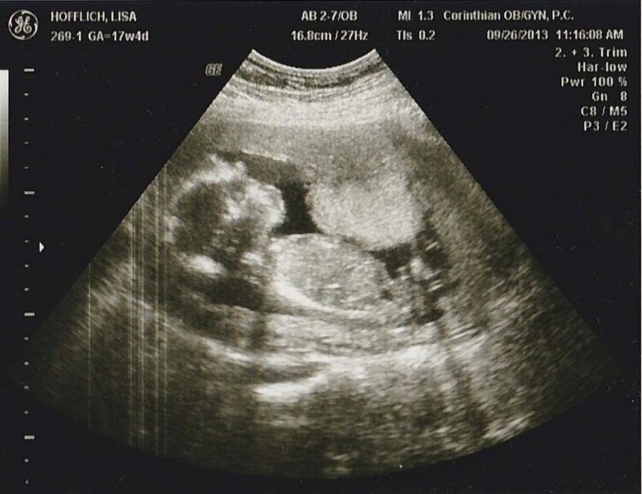 Какое узи делают на раннем сроке беременности. Снимки УЗИ. УЗИ беременности на ранних. Миома матки при беременности УЗИ.