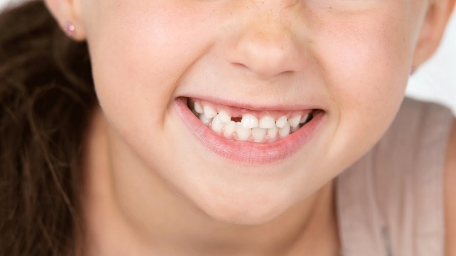 Выпадение молочных зубов: порядок и возраст начала выпадения зубов у детей