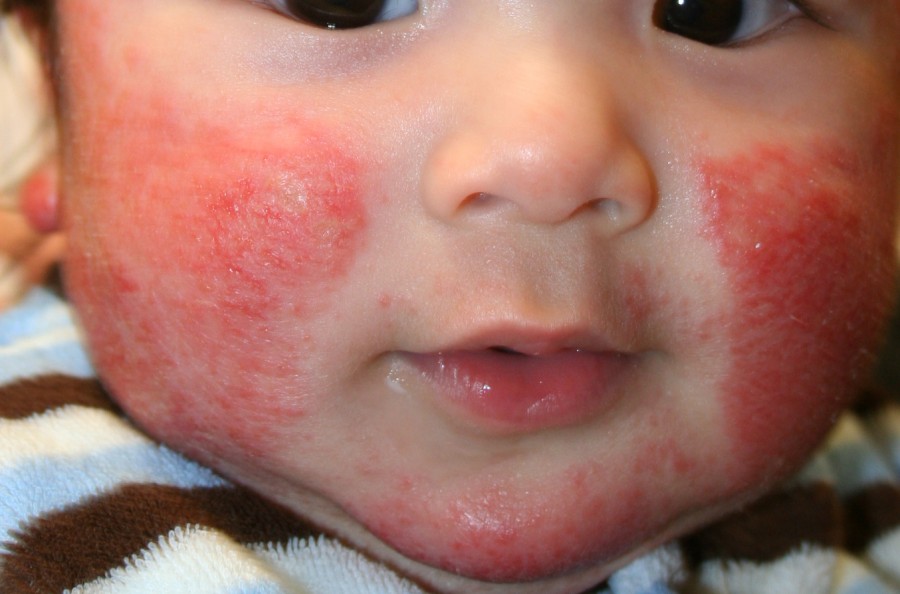 Атопический дерматит у детей - симптомы, причины, лечение и профилактика заболевания