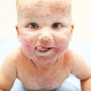 Атопический дерматит у детей – симптомы, причины, лечение и профилактика заболевания