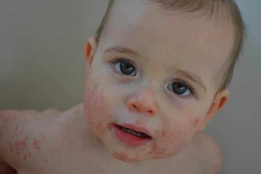 Атопический дерматит у детей - симптомы, причины, лечение и профилактика заболевания