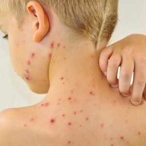 Сыпь на спине у ребенка — виды, причины появления и методы лечения (85 фото)
