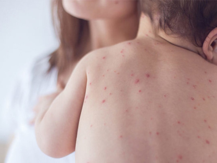 Сыпь на спине у ребенка - виды, причины появления и методы лечения (85 фото)