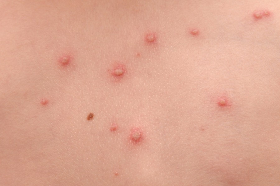 Сыпь на спине у ребенка - виды, причины появления и методы лечения (85 фото)
